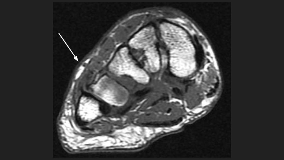 Figure 1 for case peroneus tertius ( RID2915 )